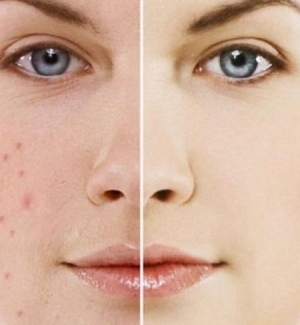 điều trị mụn trứng cá